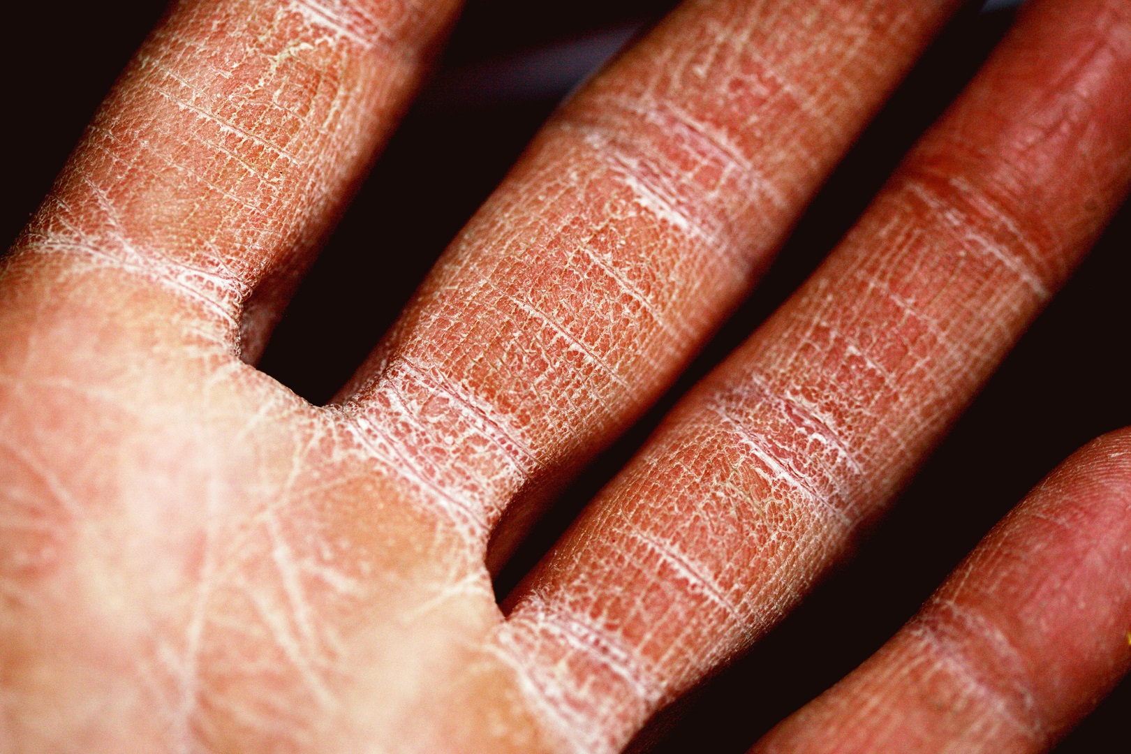 eczema piel seca agrietada mano dedos